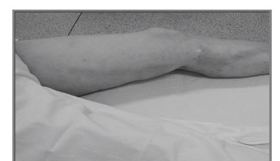 RISCO DE TROMBOSE VENOSA PROFUNDA APÓS UMA FLEBITE SUPERFICIAL